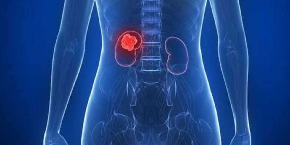 Radical Nephrectomy for Kidney Cancer Management