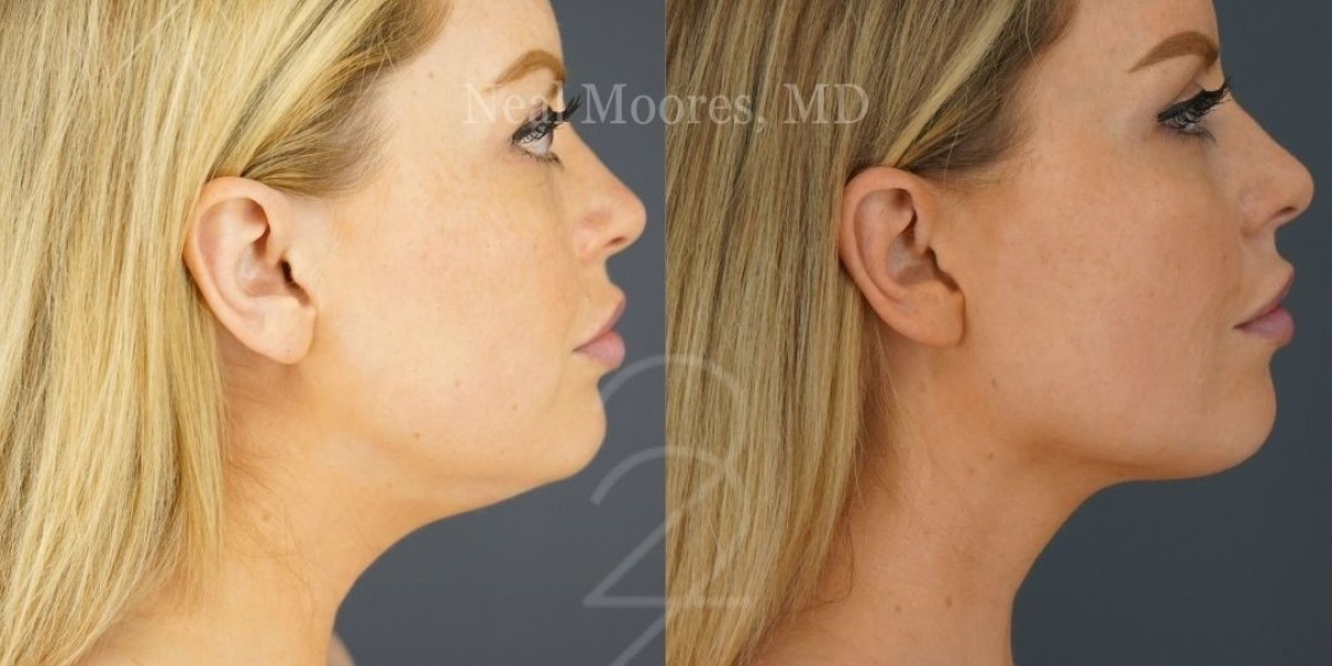 Sculpt Your Neck and Jawline with Liposuction in Salt Lake City