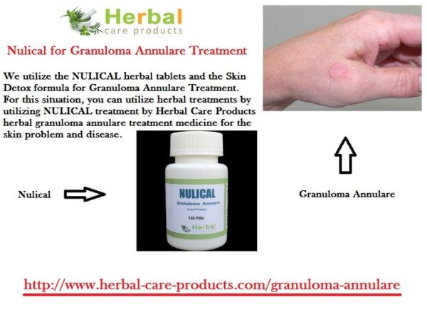 10 Natural Remedies for Granuloma Annulare - Herbal Care Products - Blog