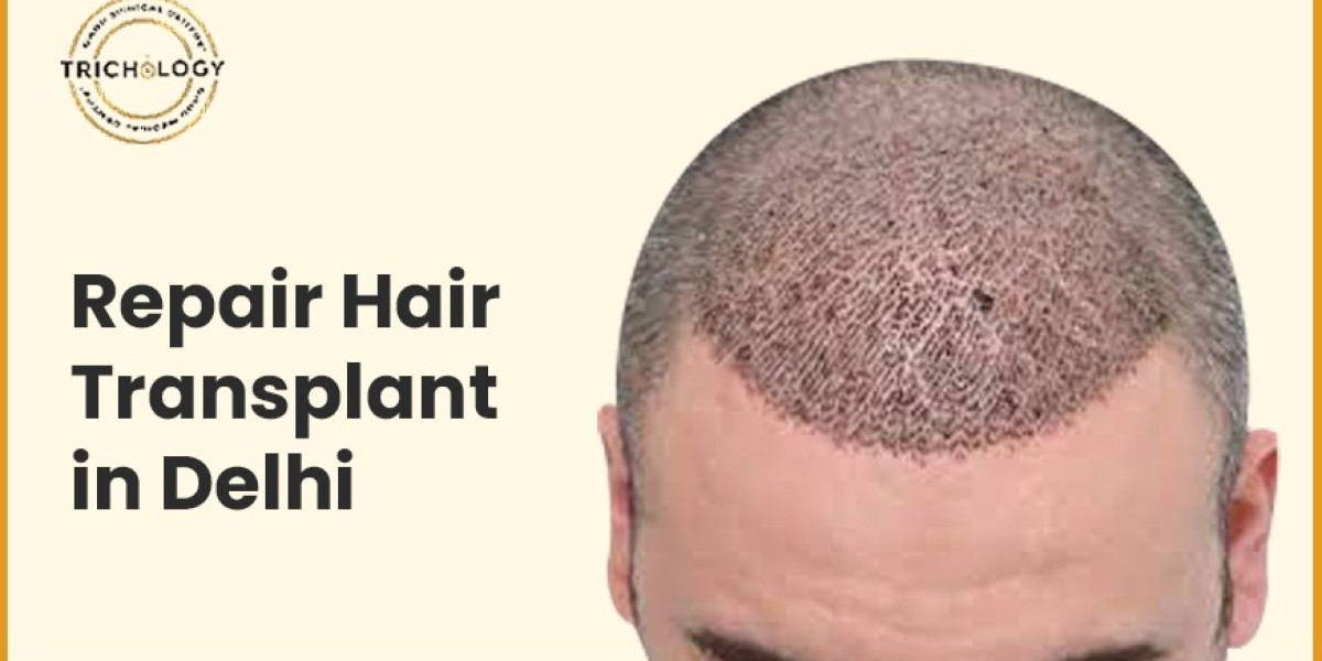 Why Did Your Hair Transplant Not Work?