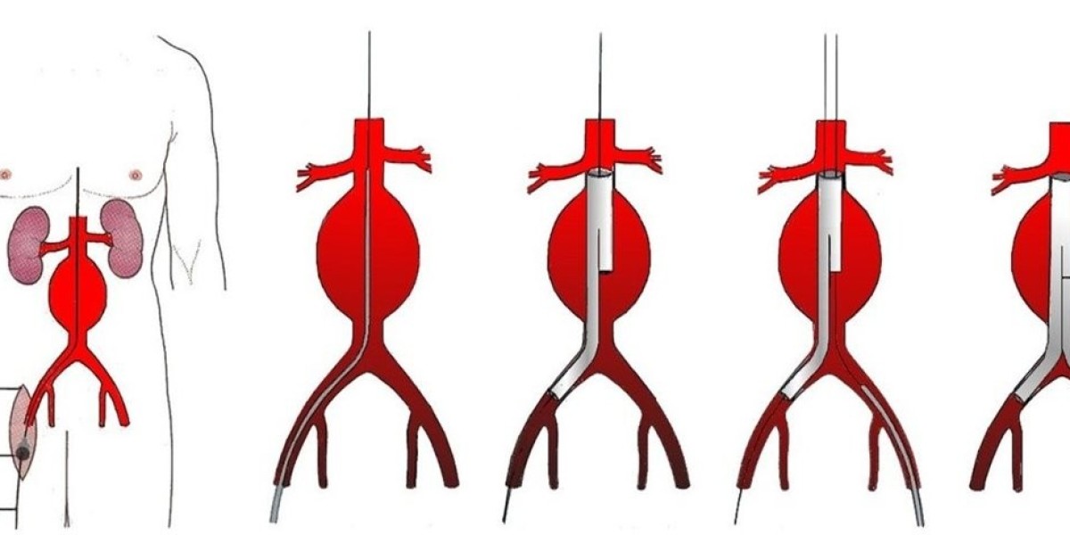 Europe Aortic Stent Graft Market Size, Share, Trends, Growth & Outlook |  2025-2034